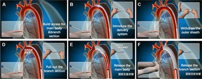 A Chinese expert consensus on thoracic endovascular aortic repair of type B aortic dissection with a single-branched stent graft for revascularization of the left subclavian artery